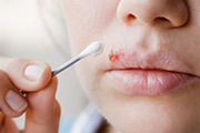 Cold Sores