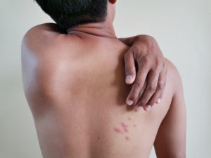 Shingles Herpes Zoster