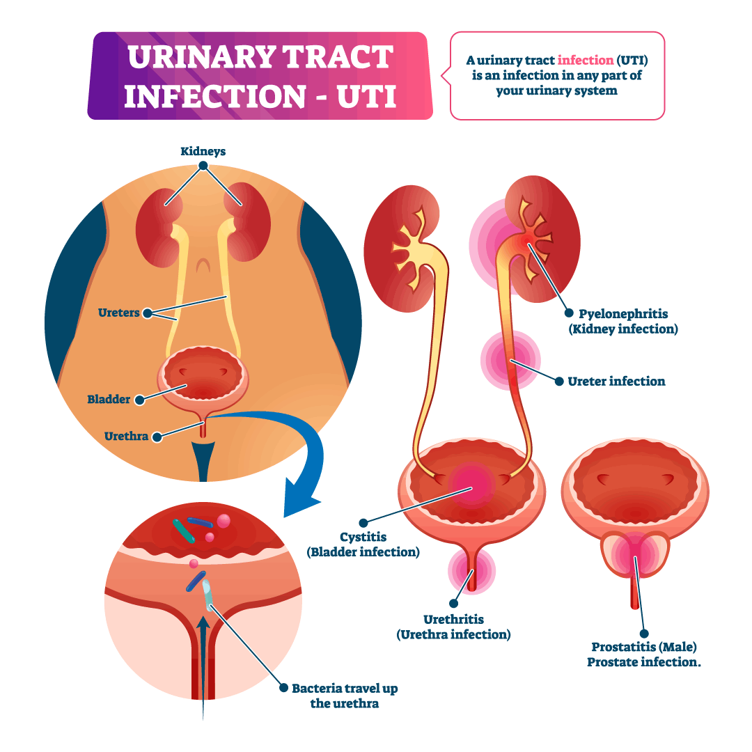 UTI Infection in Urinary system